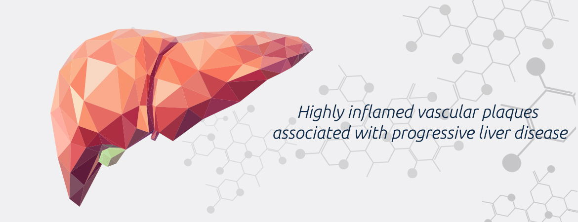 Highly Inflamed Vascular Plaques Associated with Progressive Liver Disease